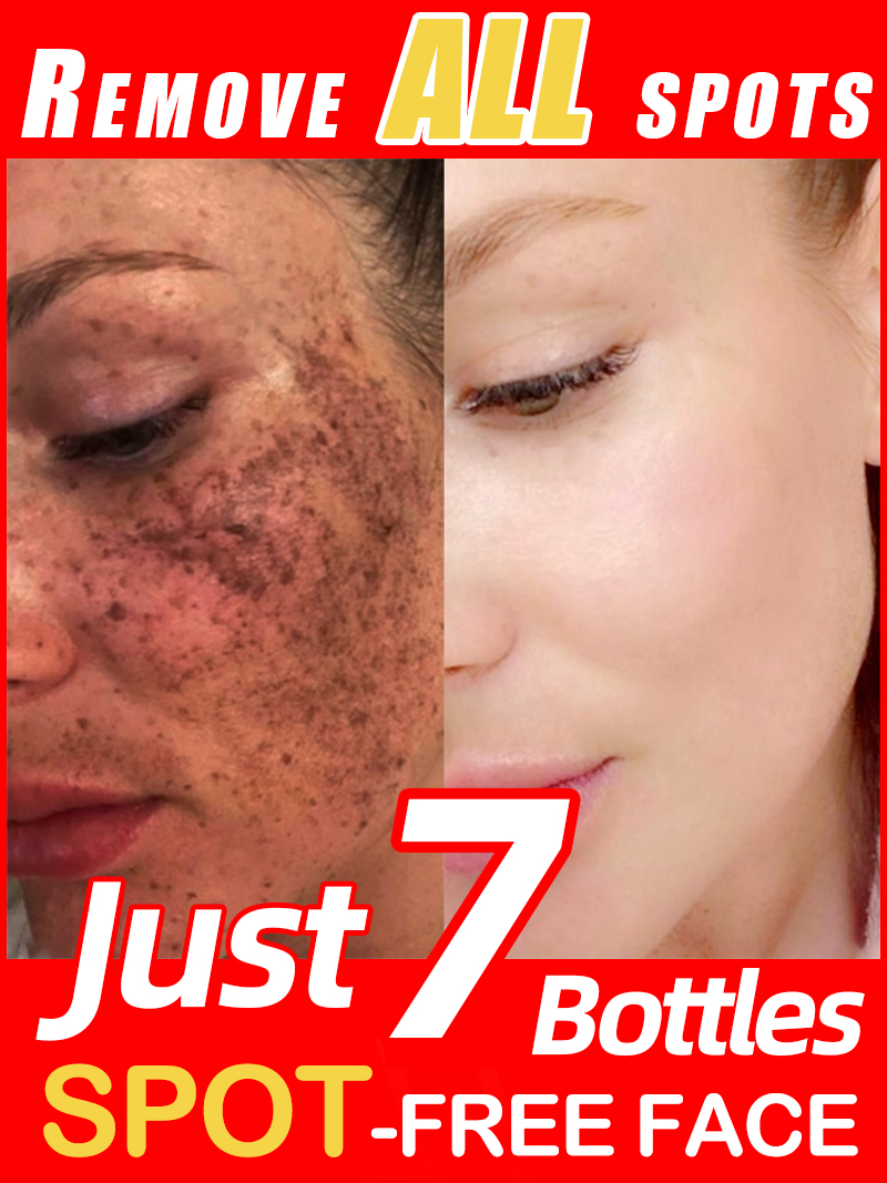 Luxury Natural Skincare - تفتيح النمش الكلف، البقع الداكنة للوجه